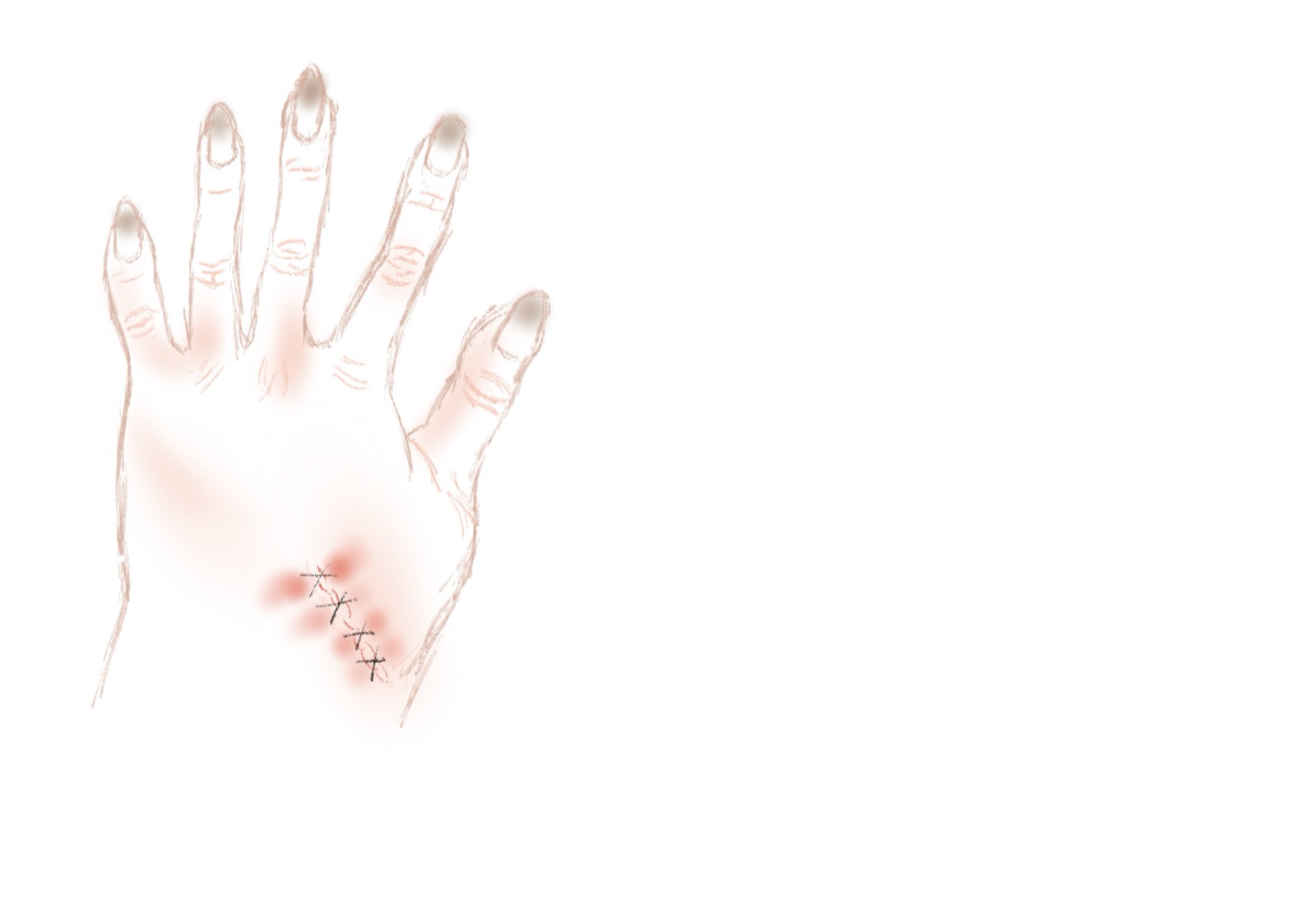 Second digital sketch of the hand with scar placement.